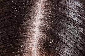 dandruff ayurvedic treatment